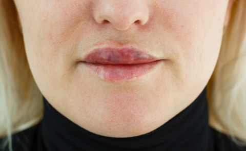 Complications & Hyaluronidase