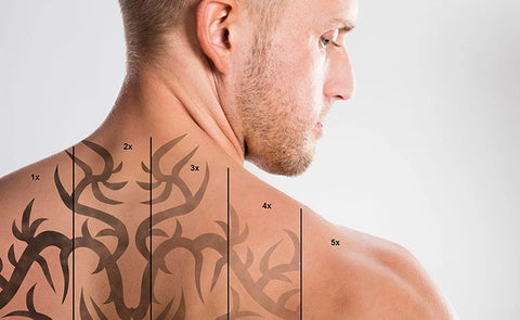 IPL Laser Tattoo Removal