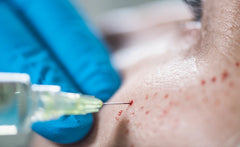 PRP Vampire Face & Hair with Phlebotomy