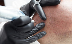 Scalp Micropigmentation