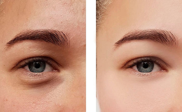 Tear Trough Masterclass