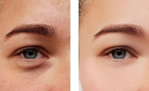 Tear Trough Masterclass