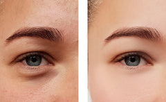 Tear Trough Masterclass